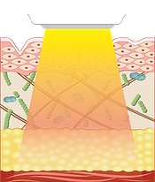 Eライト　光　高周波